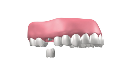 implantes dentales en Coslada