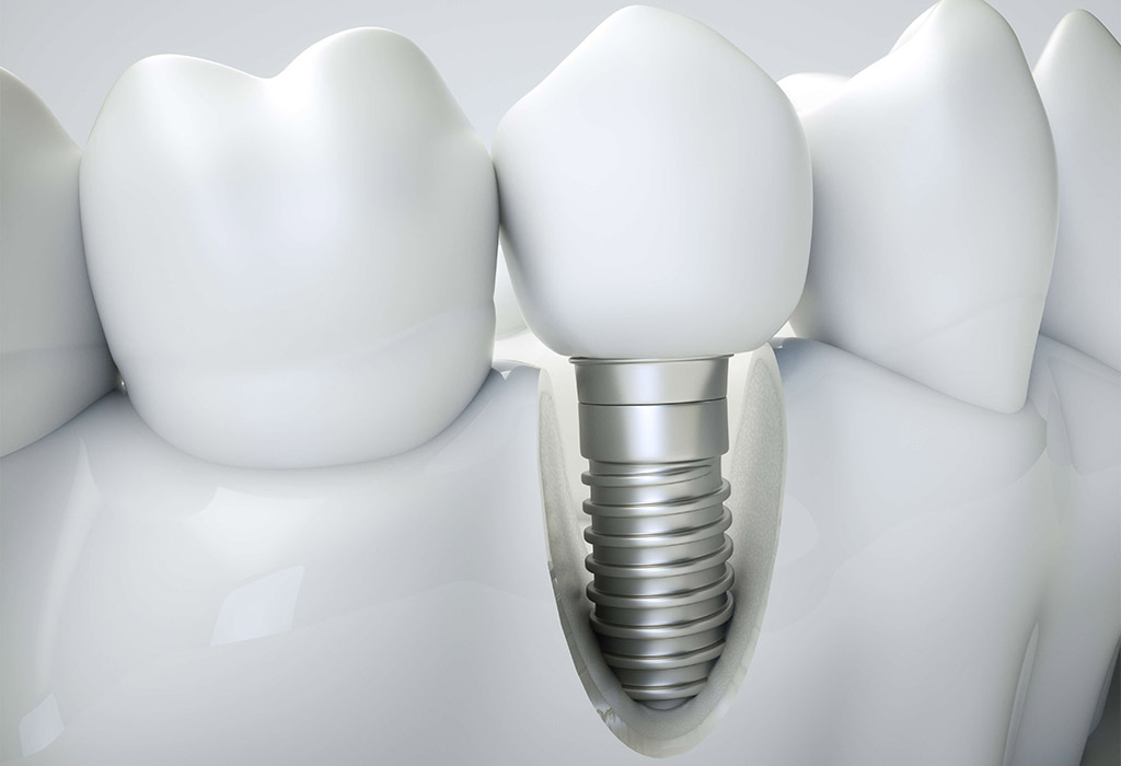 implantes dentales en Coslada